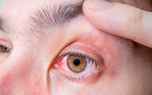 Conjuntivitis 300x188 1