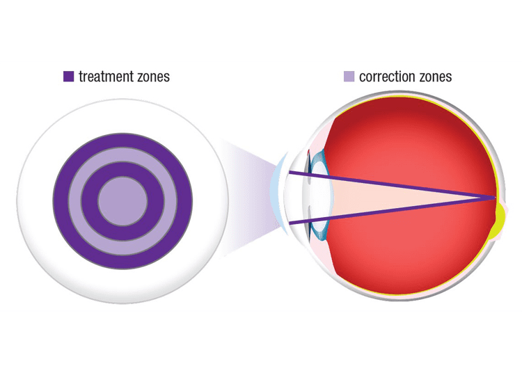 Una revisión a los avances en el manejo de la miopía Untitled 1