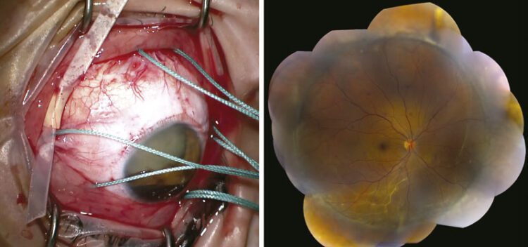 Elevación de la PIO después de procedimientos retinales