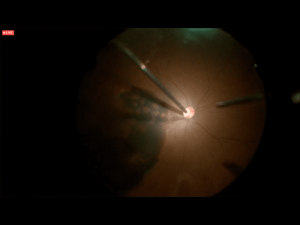 09cirugiaretina10 Nota1 2021 09 15 Oald 300x225