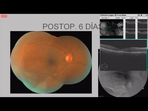 10cirugiaretina10 Nota1 2021 09 15 Oald 300x225