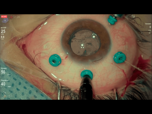 11cirugiaextrema10 Nota1 2021 09 15 Oald 300x225