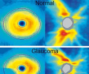 Avances en la detección y seguimiento de cambios glaucomatosos del nervio óptico