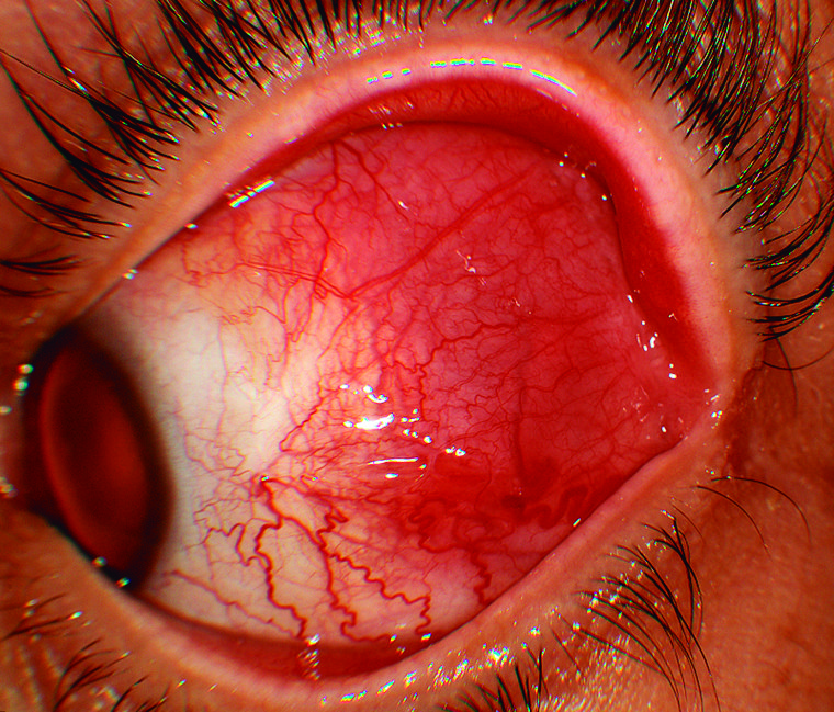 El enrojecimiento que no desaparece El enrojecimiento que no desaparece