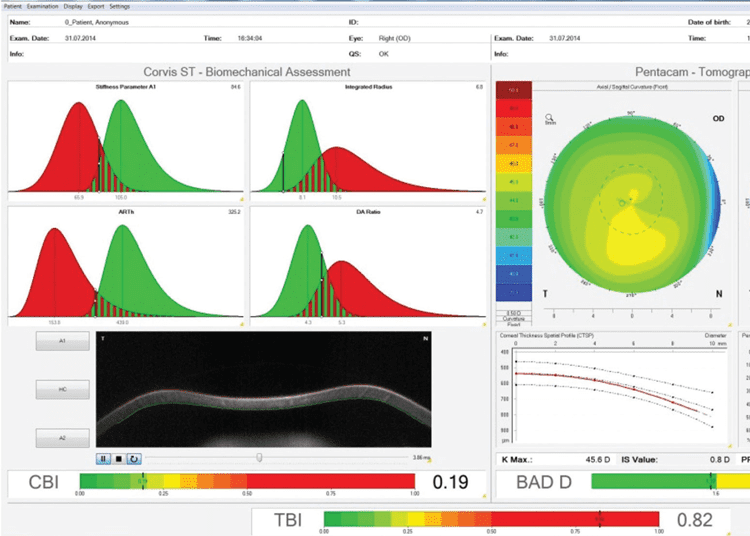 Inteligencia artificial para el especialista en córnea Untitled 1