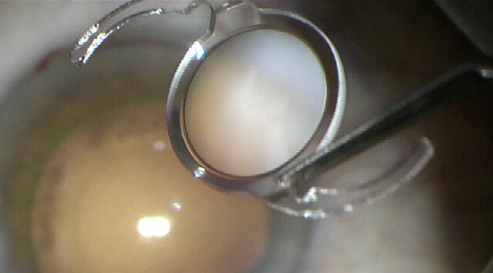 Imagen de Lente Tecnis Eyhance