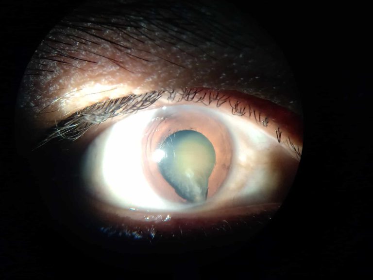 Desprendimiento de retina asociado a coloboma coriorretiniano Imagen de desprendimiento de retina