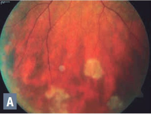 Imagen de uvelitis no infecciosa