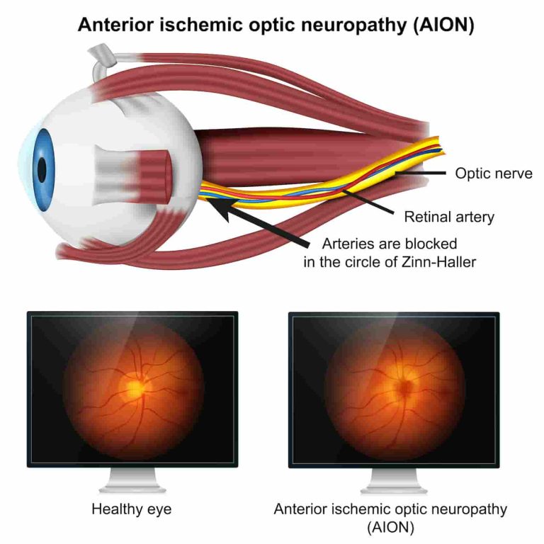 Imagen De Neuropatia Optica Compresiva 768x768