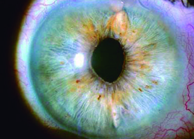 El LIO en el Sulcus: cuándo, porqué y cómo imagen de el lio en el sulcus