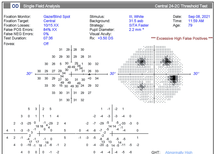 Seguimiento de la progresión del glaucoma: lo aprobado, lo verdadero y lo nuevo Untitled 1