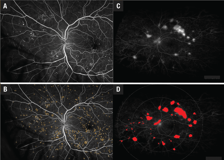 ¿Cómo la IA puede afectar la práctica de la retina? Art1