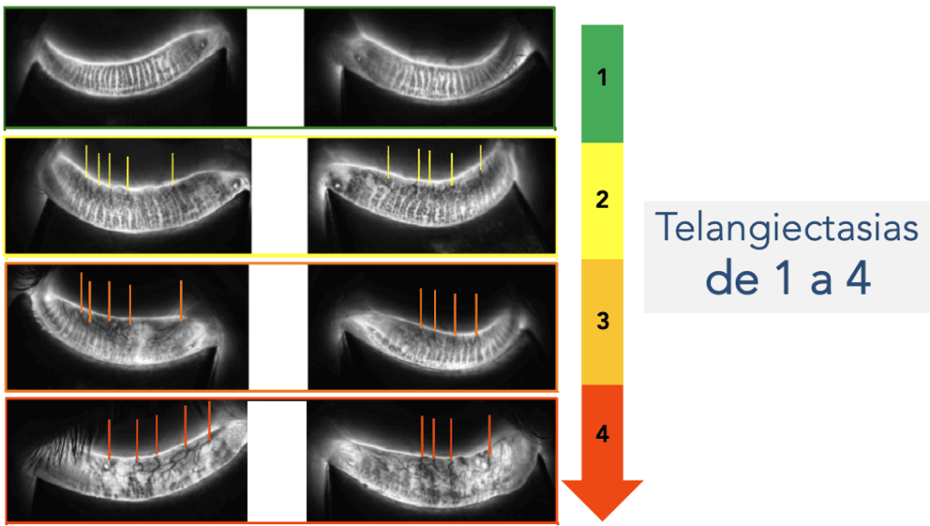 Telangiectasias 1024x580
