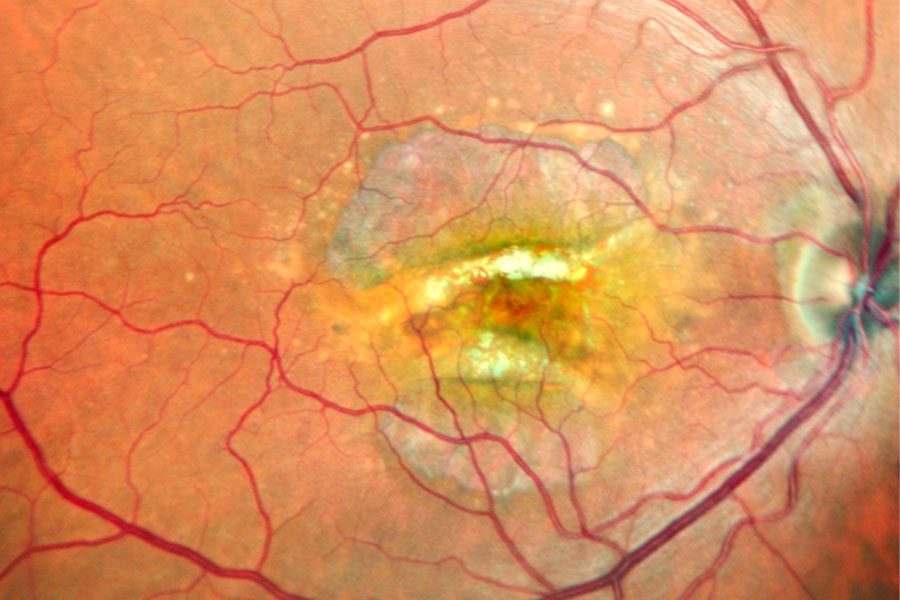 Desgarro doble de epitelio pigmentario de la retina evaluado mediante imagen multimodal Paginaweb Nota1 20 09 2023 Oald