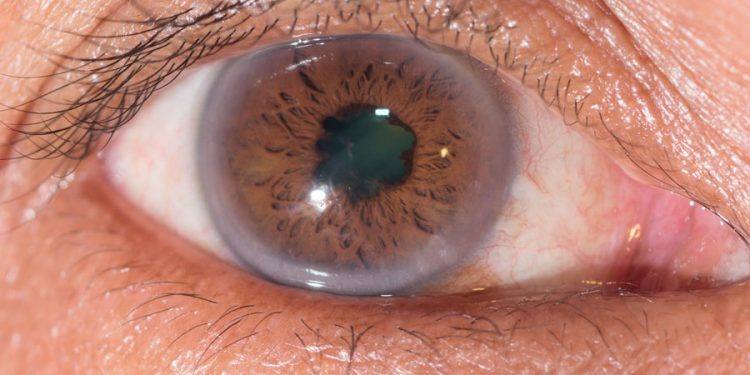 Fármacos sistémicos y cataratas