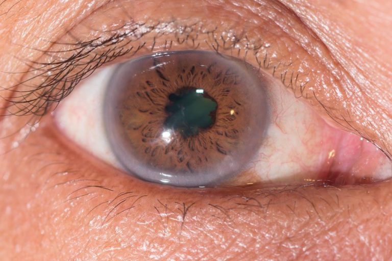 Fármacos sistémicos y cataratas Paginaweb Nota5 16 08 2023 Oald 1 768x512