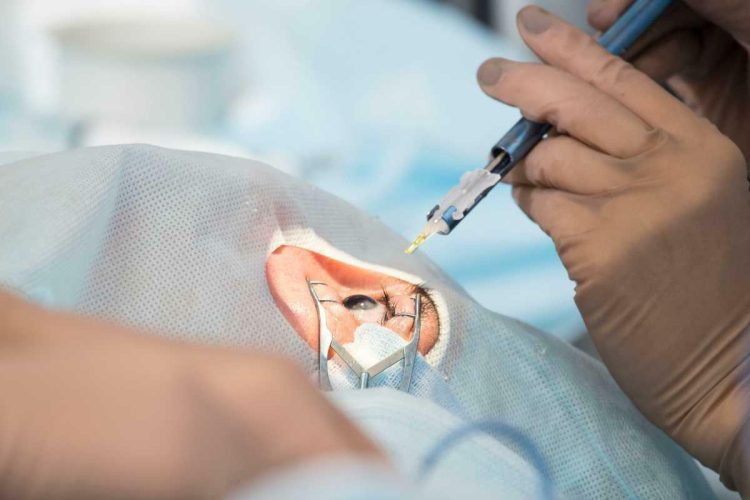 Lecciones sobre la extracción de cristalino transparente