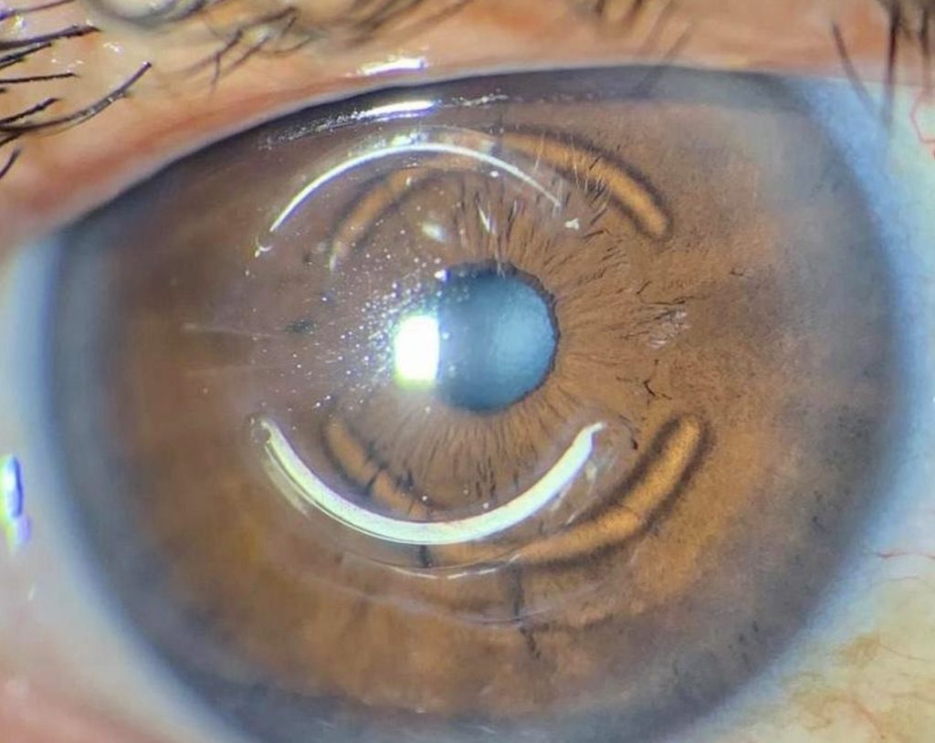 FORO NOTICIERO ALACCSA-R Figura 1 Paciente De Queratocono 1024x814