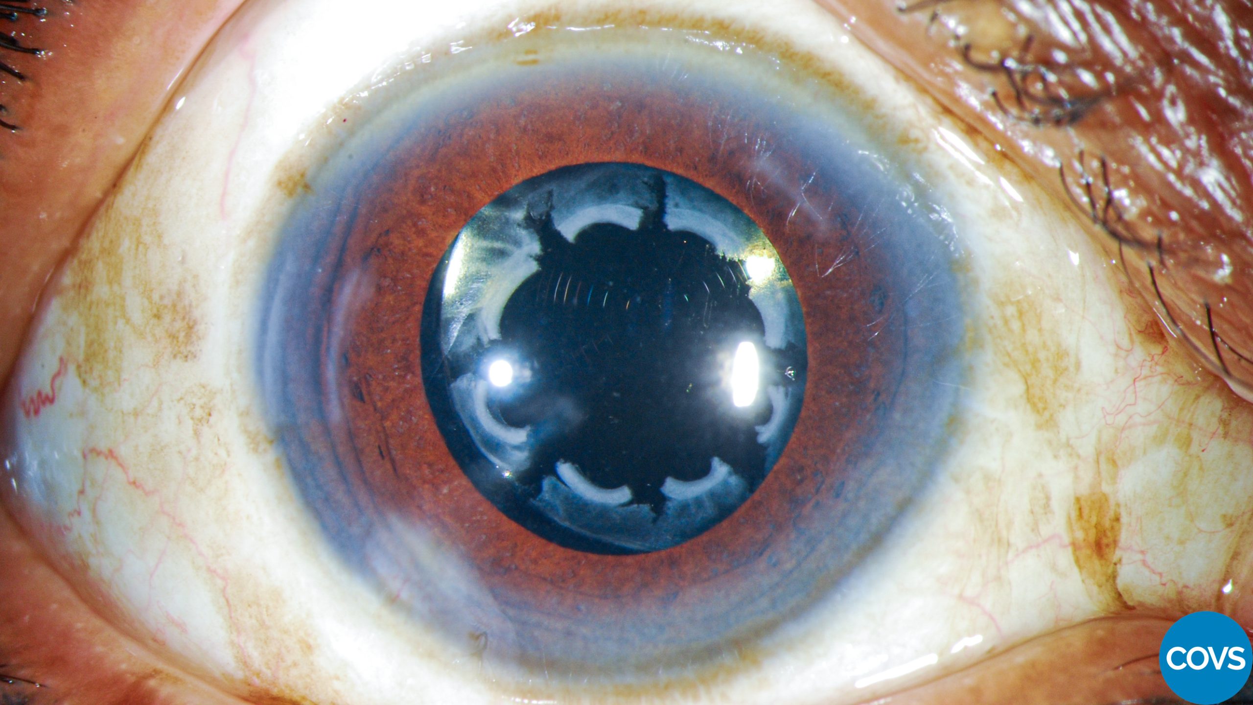 Contracción de la cápsula anterior asociado a dolor ocular bilateral con lentes intraoculares hidrofóbicos