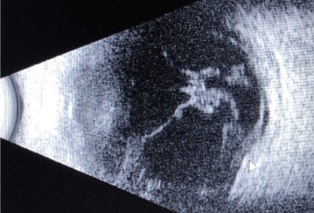 Colgajos tarso-conjuntivales para la queratitis grave