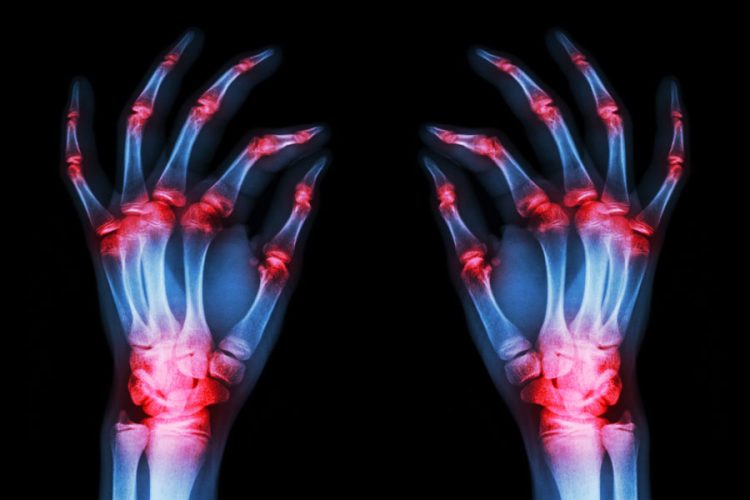 La artritis reumatoide conduce a un mayor riesgo de cataratas y glaucoma