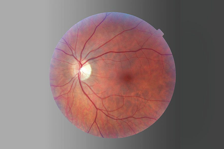 Revisión sobre la reparación del desprendimiento de retina Pagina Nota5 120624 Oald