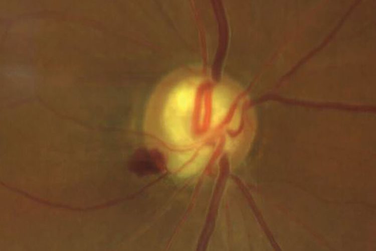 Factores sistémicos en el glaucoma