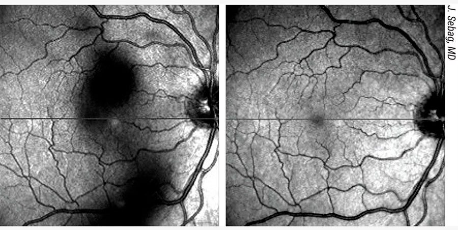 Tratamiento de las condensaciones vítreas: ventajas, inconvenientes y técnicas Pagina Nota3 13 11 24 Oald