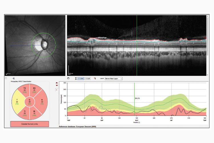 Glaucoma: Detección de artefactos de la OCT