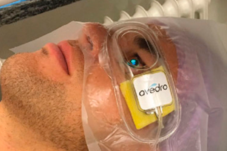 La CXL transepitelial acelerada preserva mejor el grosor corneal que la técnica epi-off