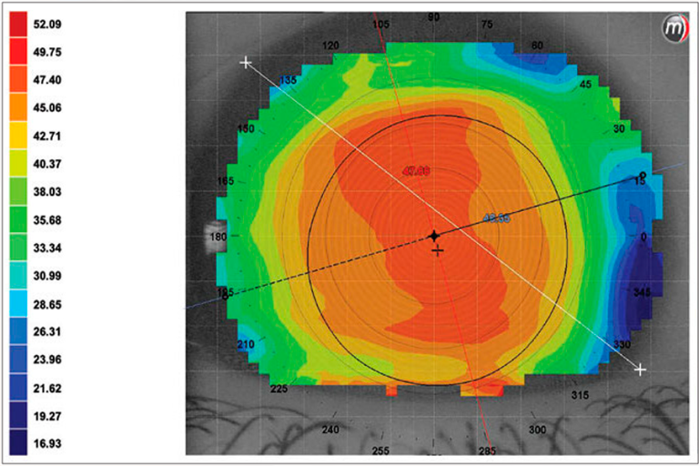 Factores de riesgo asociados a la regresión miópica tras cirugía refractiva: edad avanzada y sexo femenino Espacio 5 768x512