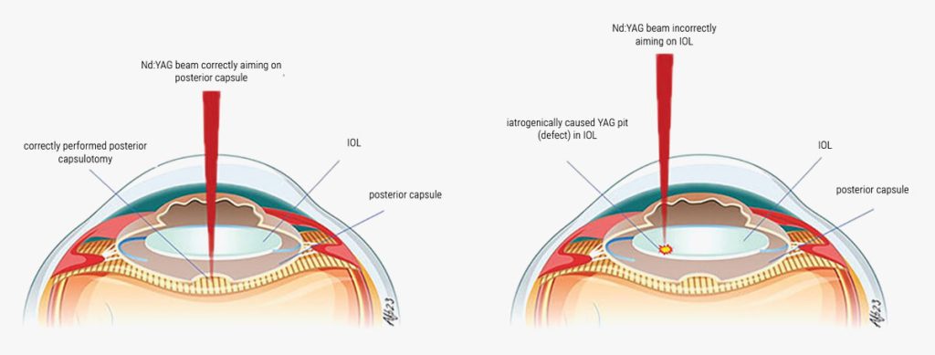 ¿Cuándo es seguro realizar una capsulotomía YAG para la opacificación capsular posterior (PCO)? Pagina Nota2 210525 Oald 1024x389