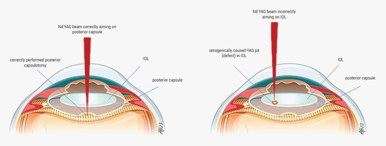 ¿Cuándo es seguro realizar una capsulotomía YAG para la opacificación capsular posterior (PCO)?