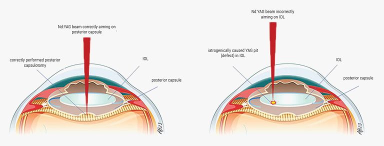 ¿Cuándo es seguro realizar una capsulotomía YAG para la opacificación capsular posterior (PCO)? Pagina Nota2 210525 Oald 768x292