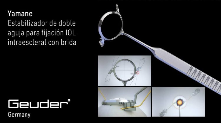 Redefiniendo la precisión en la fijación intraescleral de LIO: Estabilizador de doble aguja Yamane