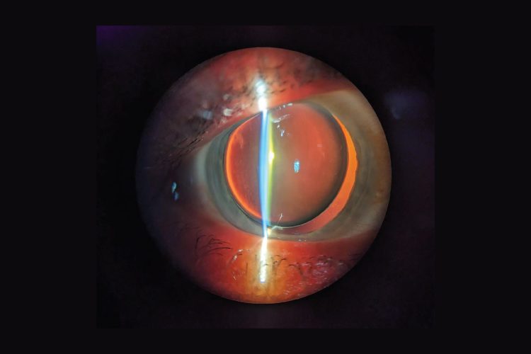 Cirugía de cataratas en ojos con antecedentes retinianos