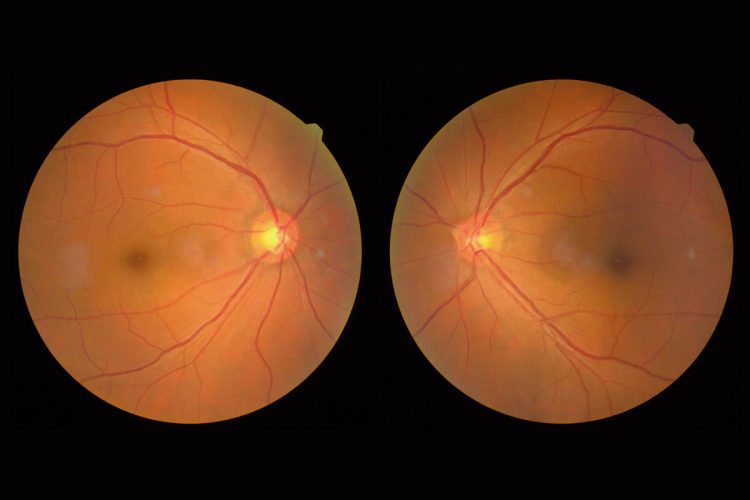 Tomografía de coherencia óptica en el tratamiento de la retinopatía diabética