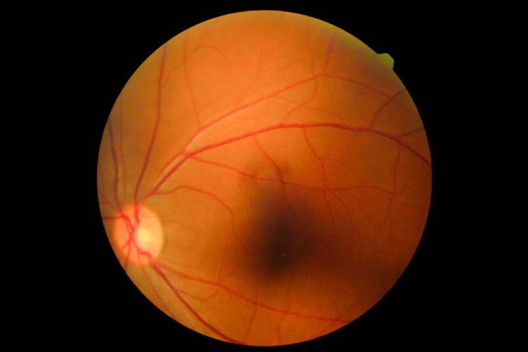 Uveítis recurrente: una revisión para especialistas en retina