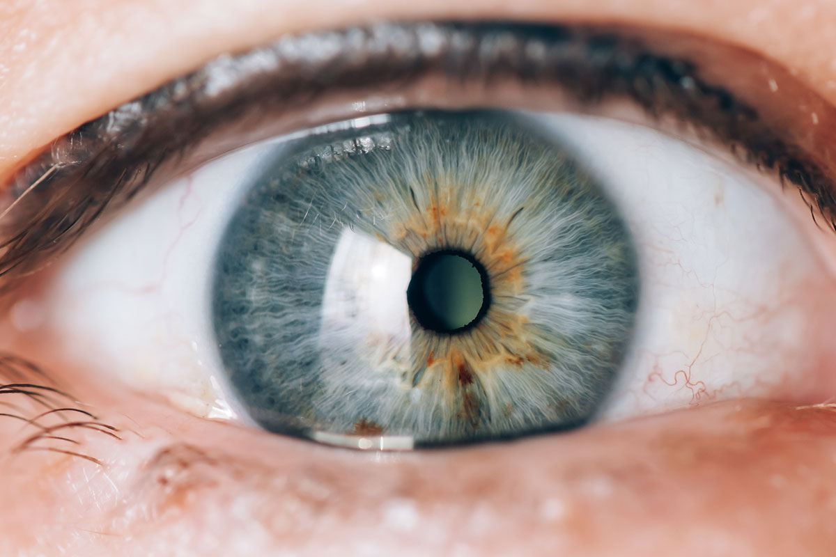 ¿Pueden los pacientes con glaucoma recibir lentes intraoculares premium?